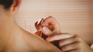 person receiving acupuncture in their shoulder