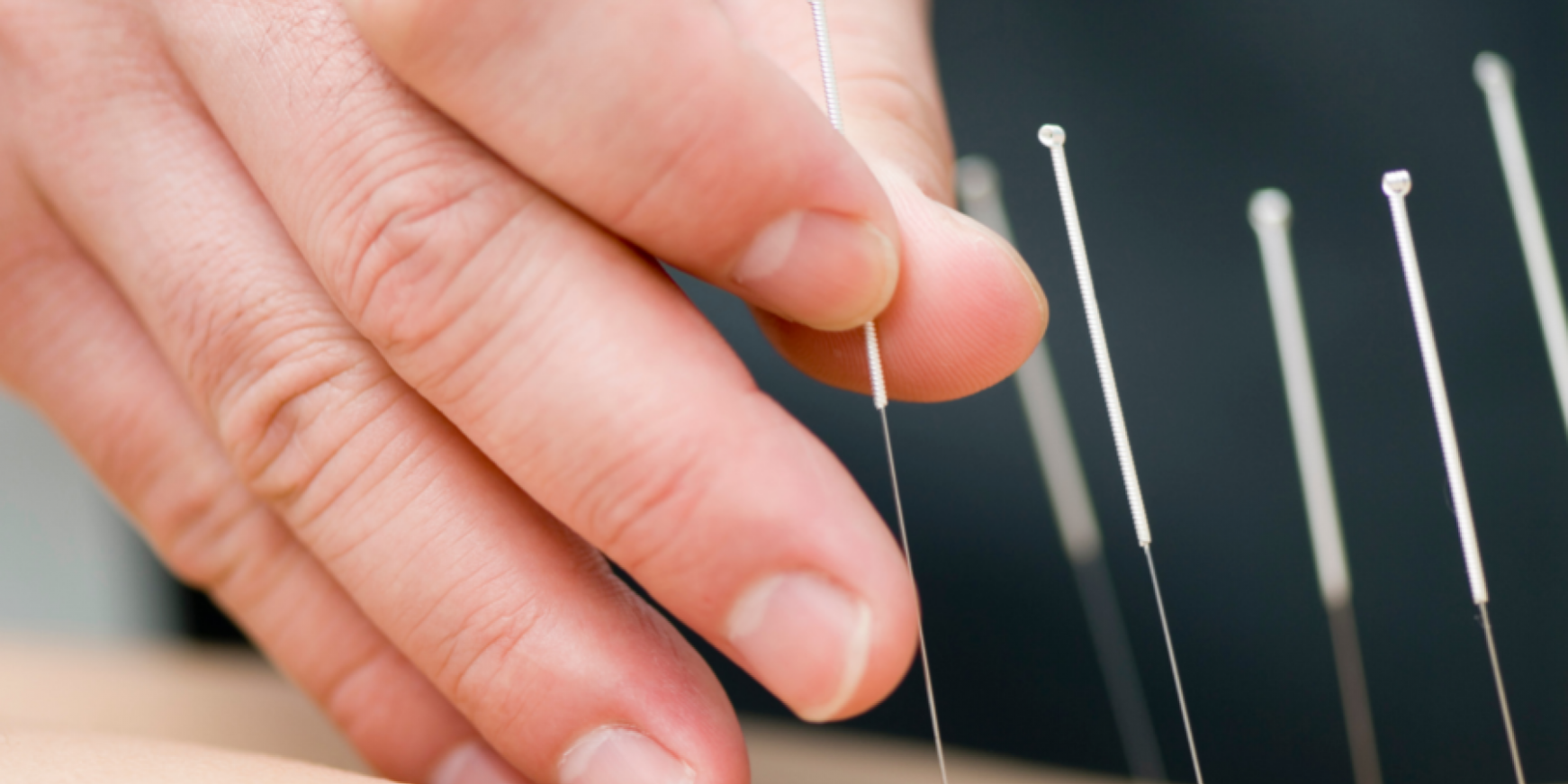 How a postural assessment feeds into an acupuncture treatment