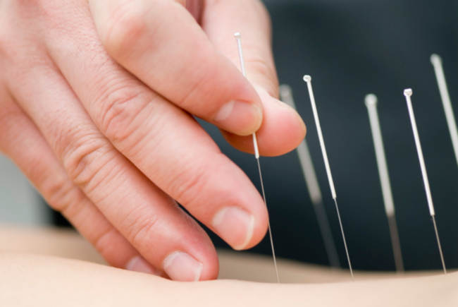 placing acupuncture needles on body